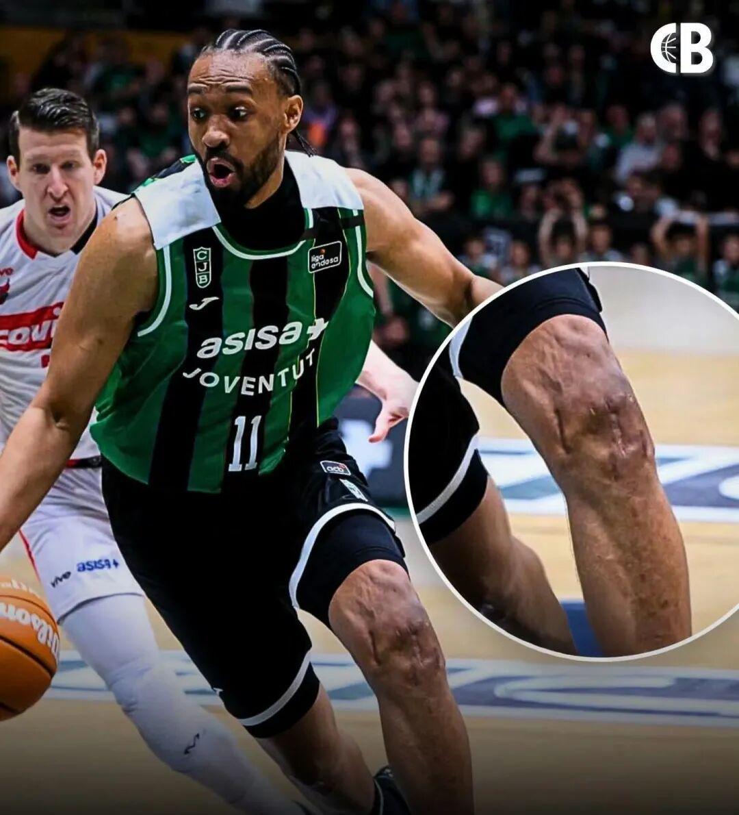 好可怕的膝盖！两次ACL撕裂，他还在打球！！！